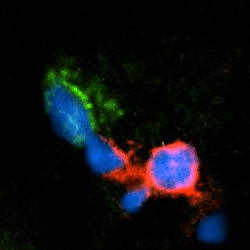 CD3+ T-cell (red) articulating with a CD20+ B-cell (green) in a human spinal cord active lesion.  T-cells present antigens to the B-cells, which then produce antibodies.